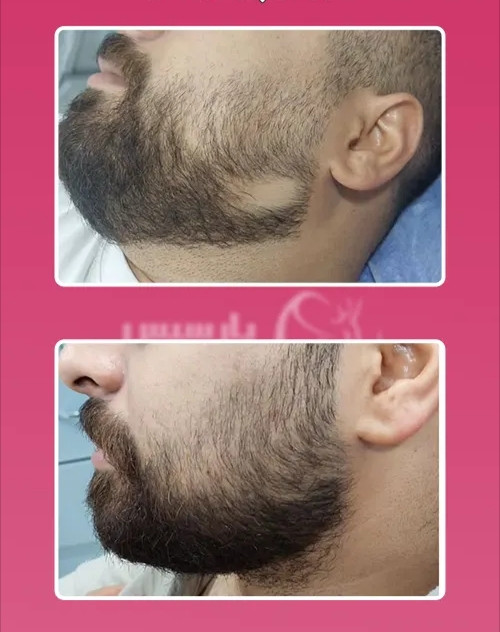 درمان ریزش مو و ریش سکه ای